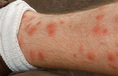 Red Spots on Legs Causes: Small, Raised, Flat or Itchy - Skincarederm