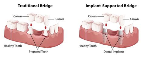 Dental Bridges - Altamonte Springs, FL - Dr. C. Scott Schmidt