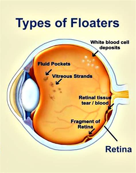 Eye Floaters | Happy Eyesight