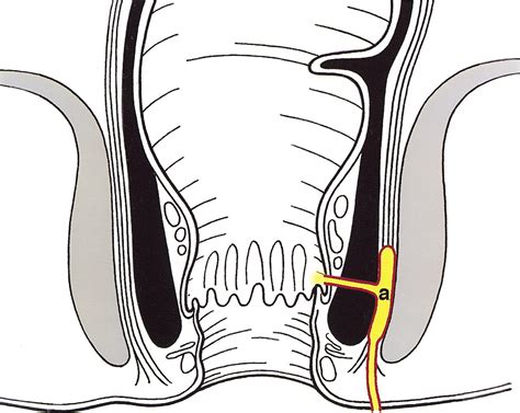 MR Imaging Classification of Perianal Fistulas and Its Implications for ...