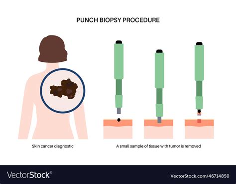 Punch biopsy procedure Royalty Free Vector Image