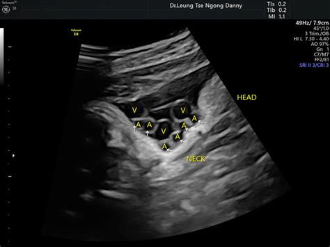 Nuchal cord (Cord round neck) - HKOG-INFO