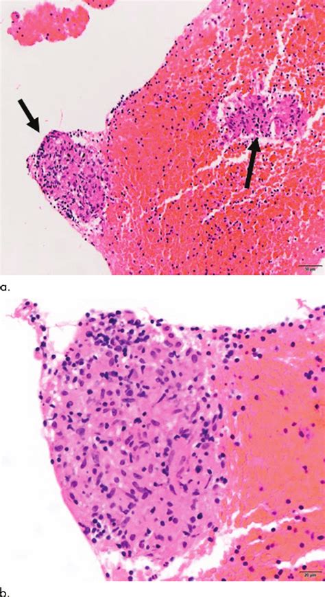 Station 7 mediastinal lymph node biopsy results. (a) Histopathology ...