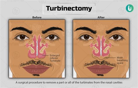 Swollen Nasal Turbinates