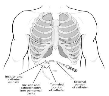 Placement and Care of your Aspira Drainage Catheter (Interventional Radiology) | Health and ...