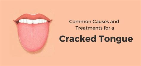 Common Causes & Treatments for Cracked Tongue | Daily Health Cures