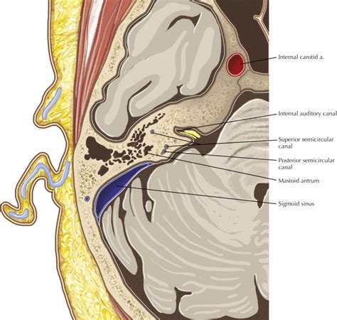 Temporal Bone (Middle Ear, Cochlea, Vestibular System) | Radiology Key