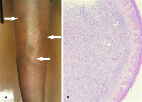 Nodular pretibial myxoedema after treatment of Graves disease with radioactive iodine ablation ...