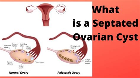 What is a Septated Ovarian Cyst - YouTube