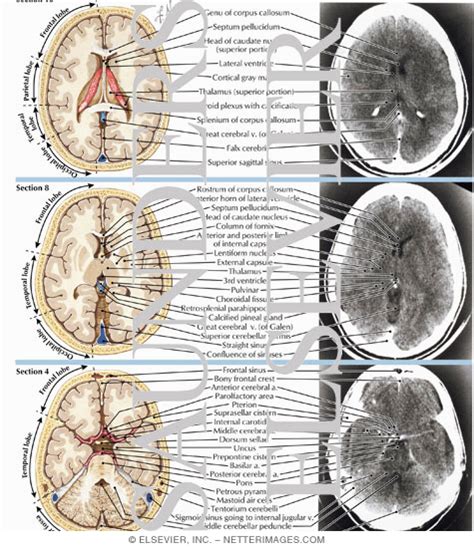 Ct Brain Anatomy