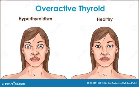 Face of an Adult Female Exhibiting the Symptoms of Hyperthyroidism. Stock Vector - Illustration ...