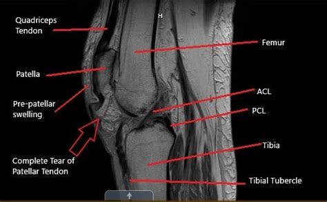 Patellar Tendon Rupture | Treatment, surgery and rehabilitation | SportsMD