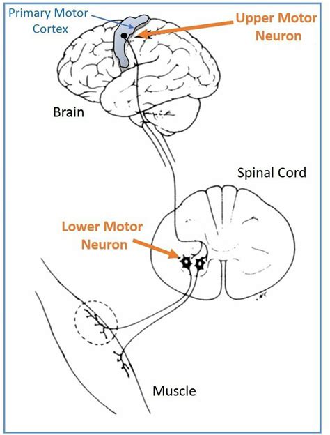 Upper motor neuron and lower motor neuron | Motor neuron, Neurons ...