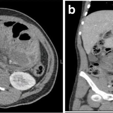 a, b Normal terminal ileum on colonoscopy | Download Scientific Diagram