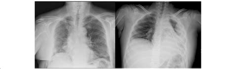 On the right: a case of elevated hemidiaphragm detected by both chest... | Download Scientific ...