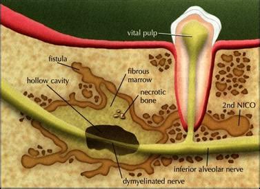 What is a Cavitation? Cavitation and Wisdom Teeth Removal