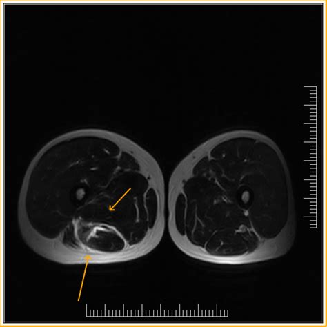 Biceps Femoris Tear-MRI - Sumer's Radiology Blog