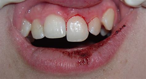 FAQ - Loose tooth — Discovery Pediatric Dentistry