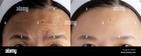 forehead wrinkles problem. pictures compared effect Before and After treatment for forehead ...