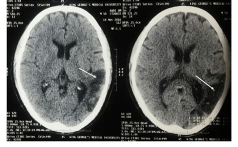 CT scan of the brain showing hypodense lesion involving the left ...