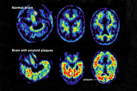 How To Diagnose Alzheimer's Disease - Askexcitement5