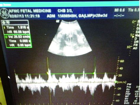 Complete congenital foetal heart block: a case report. - Abstract ...