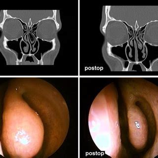 Bulbous type concha bullosa: preoperative and postoperative CT and... | Download Scientific Diagram