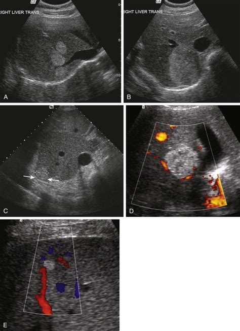 Benign Tumors of the Liver | Radiology Key