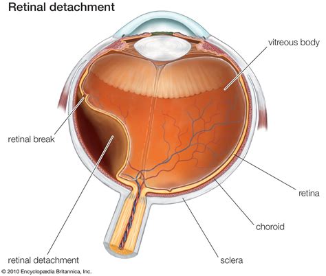 Retinal Detachments - Dr Lynette Venter | Ophthalmologist | Eye | South Africa