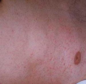 HealthoolTyphus Fever Rash Pictures Atlas of Rashes Associated With Fever Epidemic Typhus fever ...