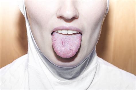 Glossitis: Causes, Symptoms, and Treatment