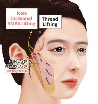 Non-incision SMAS Lift creating a ‘Young-looking’ face 【ID Hospital】