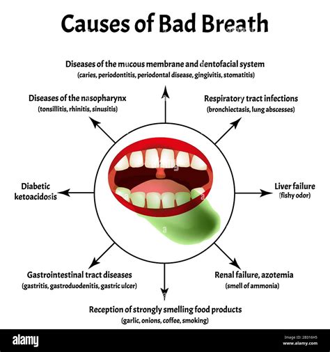 Causes of bad breath. Halitosis. The structure of the teeth and oral ...