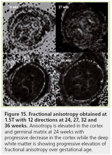 MRI assessment of neonatal brain maturation