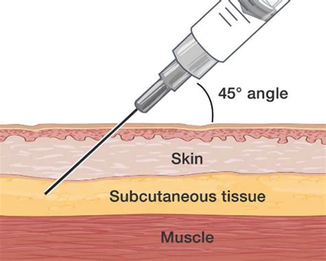 Subcutaneous injection sites, how to give subcutaneous injection & technique