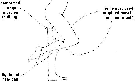 Multiple Sclerosis Research: MS Basics - SPASTICITY