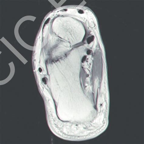 Hypertrophic peroneal tubercle and the thickened peroneus longus with... | Download Scientific ...