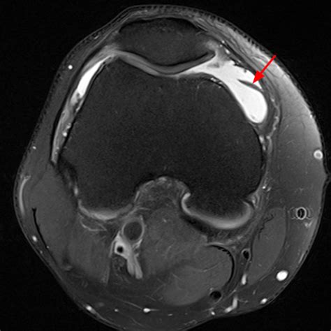 Synovial Plicae of the Knee | Radsource