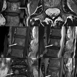 Atypical Hemangioma Spine Mri