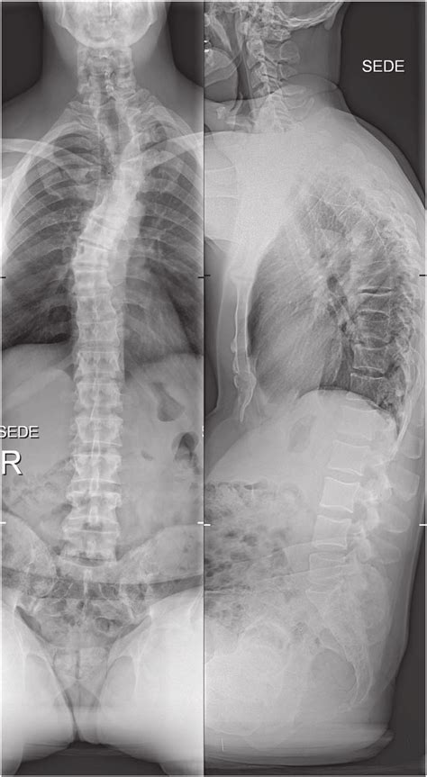 The initial X-ray images of the thoracic spine at the time of admission ...