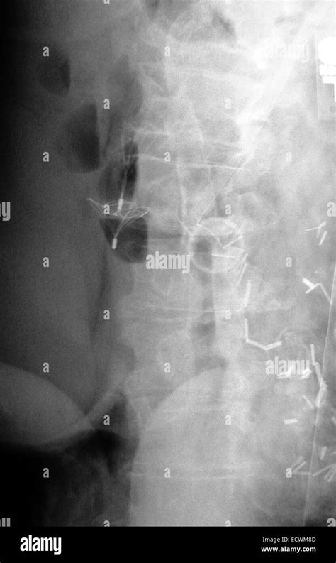 abdomen x-ray showing a vena cava blood clot filter Stock Photo - Alamy