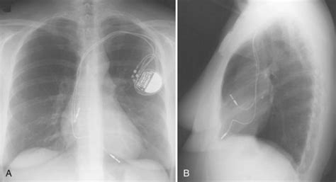 Imaging of Implantable Devices | Thoracic Key