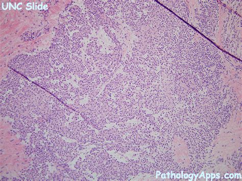 glomus tumor pathology