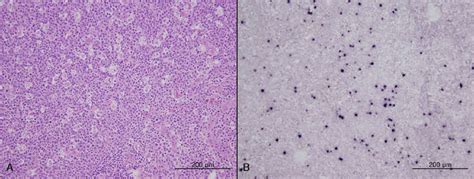 Excisional biopsy of the inguinal lymph nodes revealed atypical... | Download Scientific Diagram