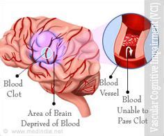 vascular dementia on Pinterest