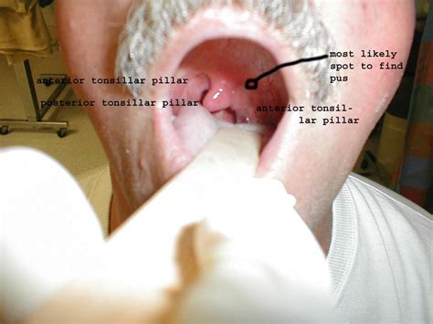 Peritonsillar Abscess Management | Iowa Head and Neck Protocols