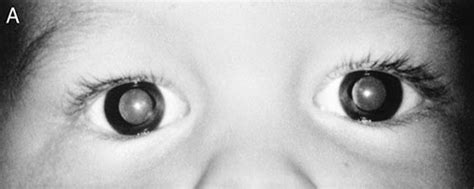 Anisometropic Amblyopia: 5 year-old male with unequal vision.