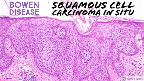 Squamous Cell Carcinoma In Situ Histology