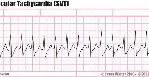 ECG Educator Blog : Supraventricular Tachycardia (SVT)