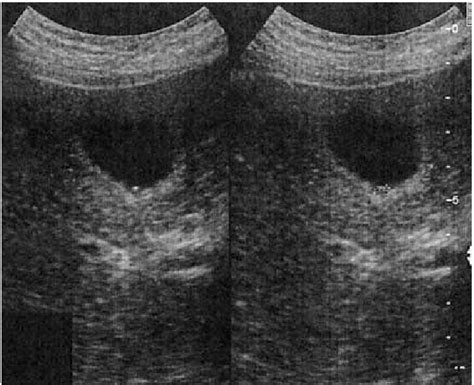 Left lateral decubitus axial US image in a male high-SCI patient shows... | Download Scientific ...